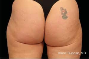 EMTONE Glutes After